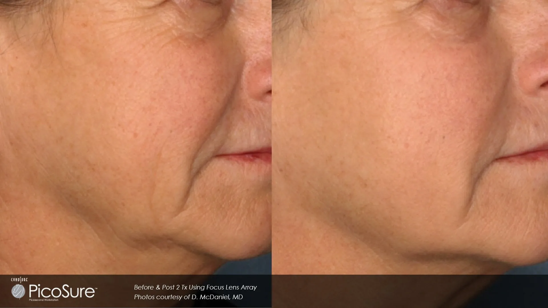 Pigmentation lesions treatment results